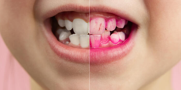 Voorkomen van tandplak en tandsteen
