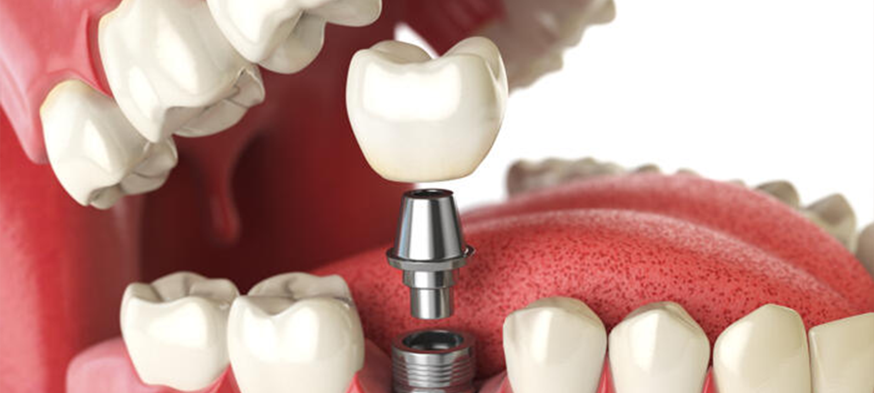 Het onderhouden van implantaten