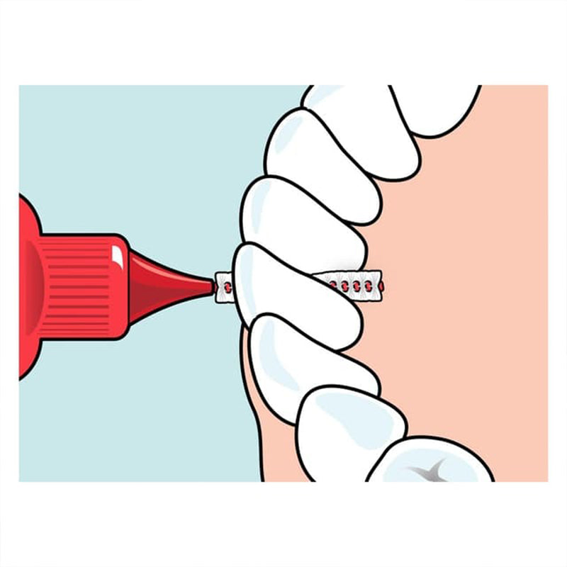Tepe Original ragers rood 0,5mm illustratie van gebruik tussen kiezen