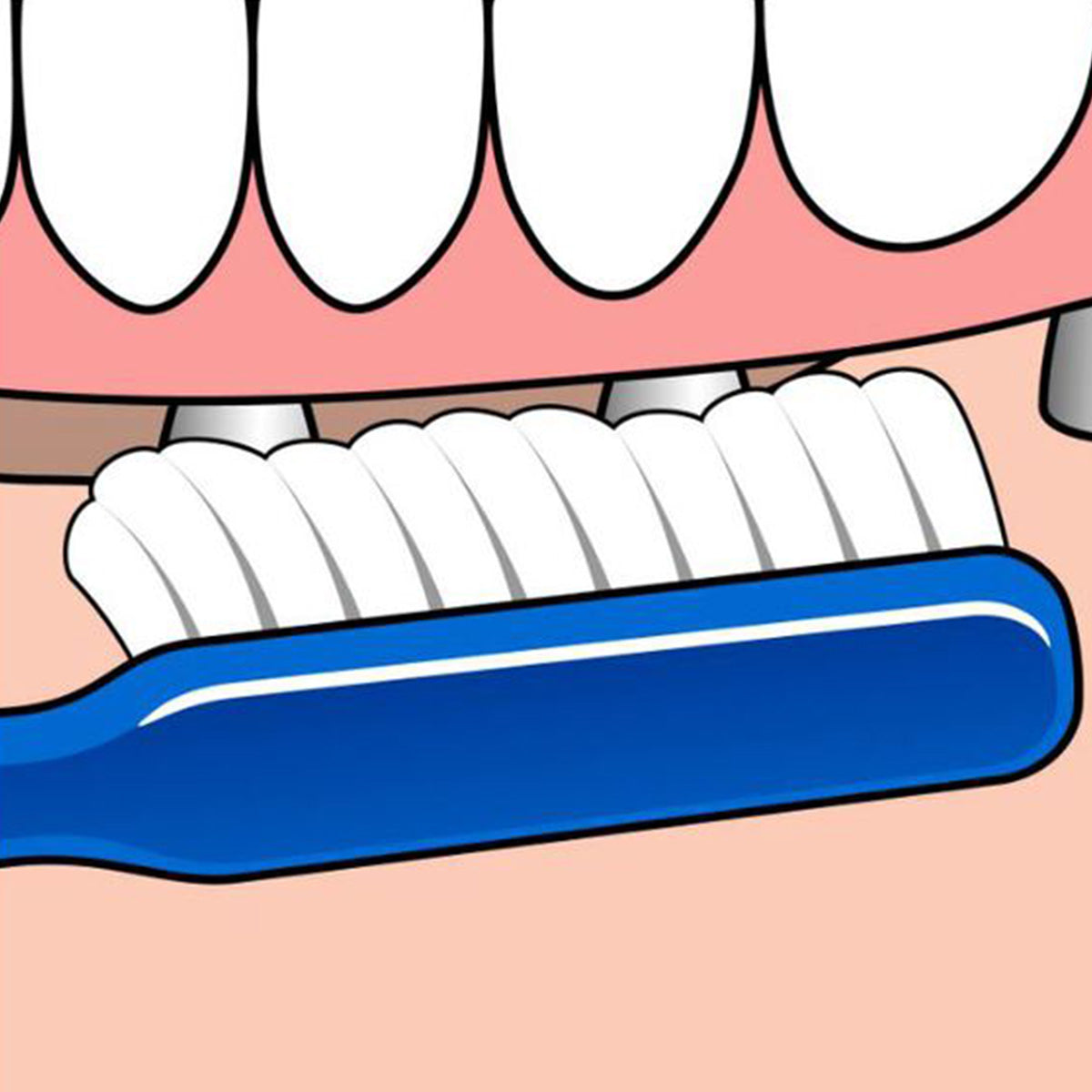 Tepe Implant/Orthodontie tandenborstel illustratie reiniging tanden bij tandvlees