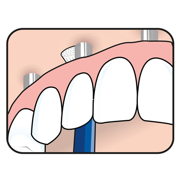 Tepe Universal Care tandenborstel illustratie van poetsen langs tandvlees en implantaten