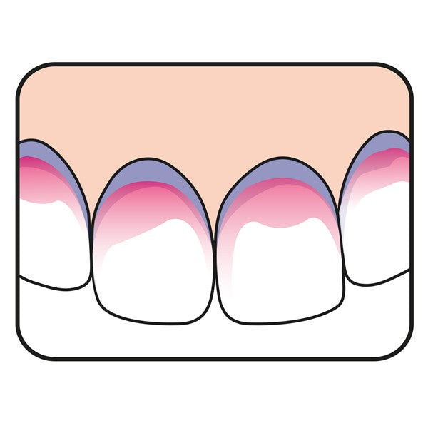 TePe Plaqsearch illustratie van tanden met roze aangekleurde plaque bij tandvlees
