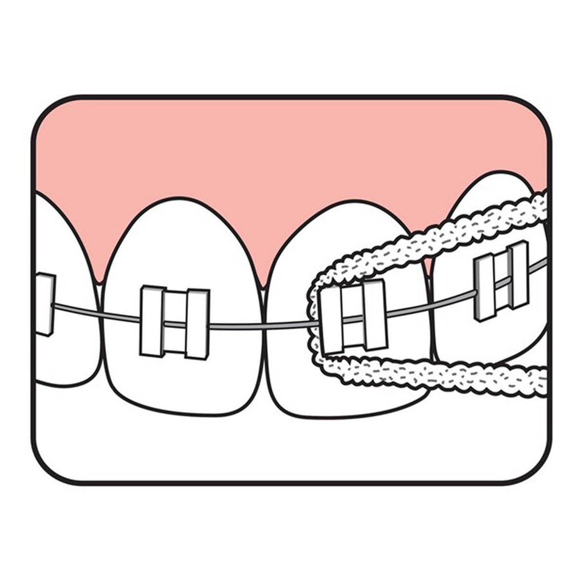 TePe Bridge & Implant Floss illustratie van rijgdraad tussen tanden met beugel