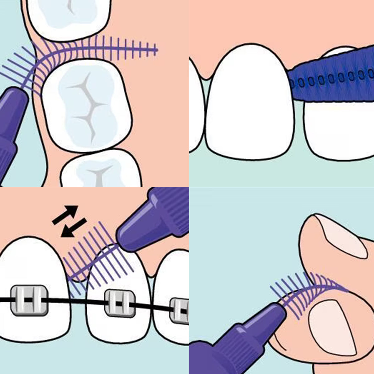 Tepe EasyFit rager gebruiken tussen kies, tand, beugel en tandvlees