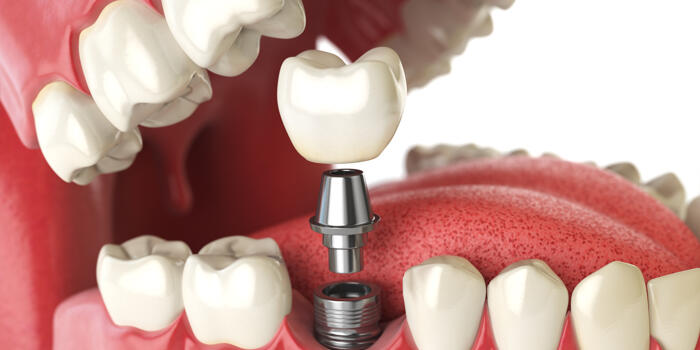 Het onderhouden van implantaten
