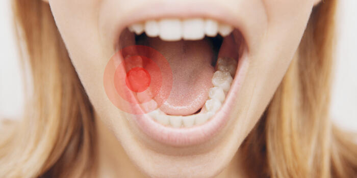 Caries.jpeg